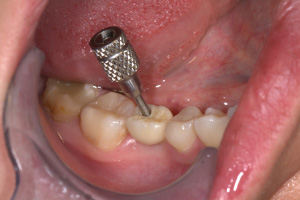 Hambaimplantaadid